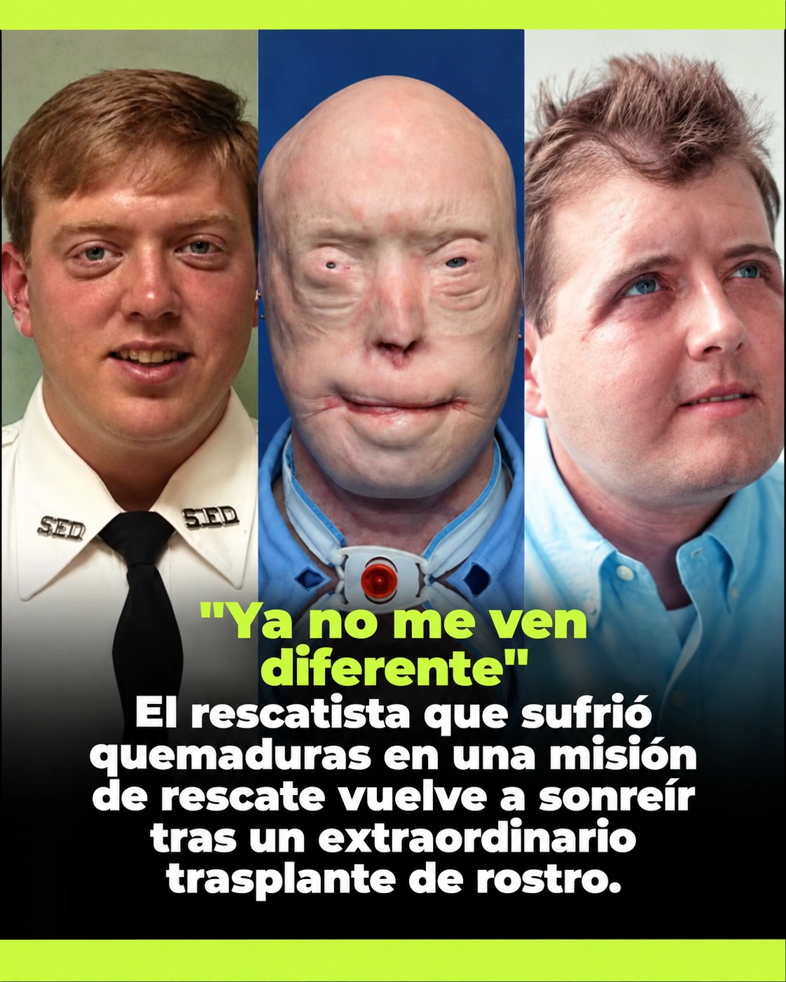 Patrick Hardison antes de las quemaduras, antes del trasplante y después de su recuperación